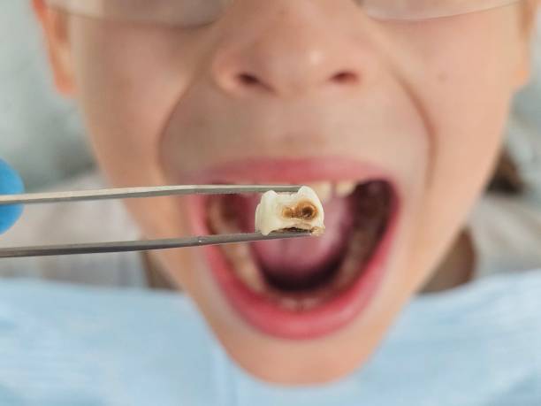 Best Emergency Treatment for Dental Infections or Abscesses in Mulberry, OH